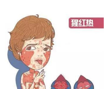 猩红热